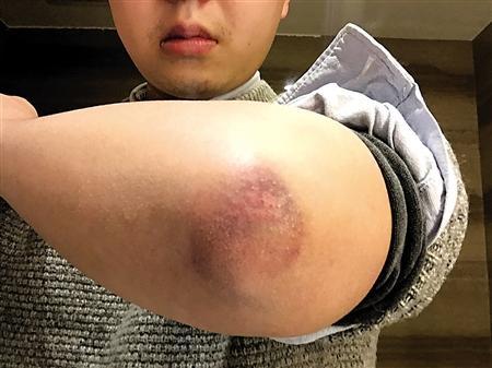 男子每天床上玩手机　手臂竟无法伸直