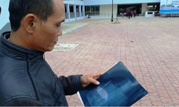 越南手术乌龙　剪刀留体内18年才发现